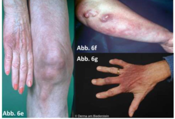 Atrophes Stadium der ACA