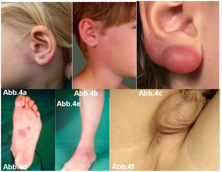 Borrelien Lymphozytom