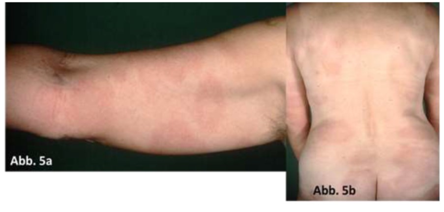 Multiple Erythemata migrantia Erw.