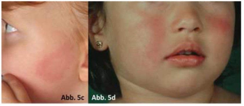 Multiple Erythemata migrantia