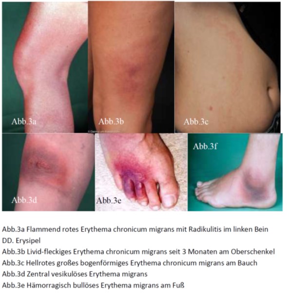 atypisches Erythema migrans